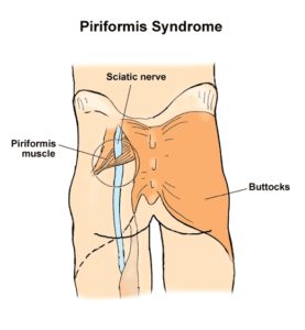 sciatic_nerve_passes_through_piriformis_muscle